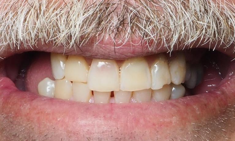 Emergency-Dental-Treatment-After-Image