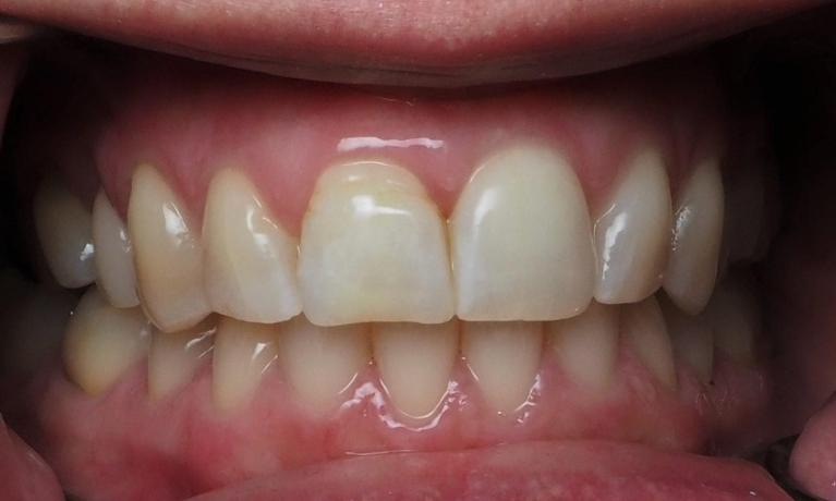 White-Spot-Treatment-with-ICON-After-Image