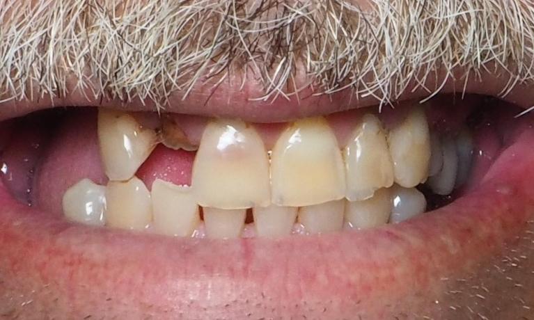 Emergency-Dental-Treatment-Before-Image