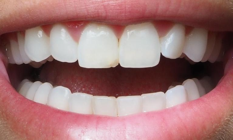 Dental-Bonding-Before-Image