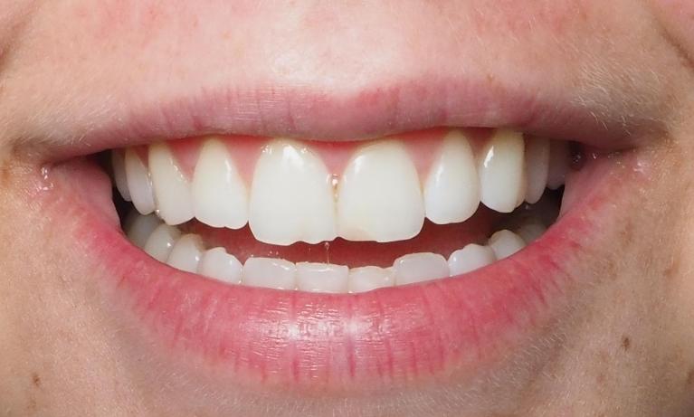 Esthetic-Edge-Bonding-Before-Image