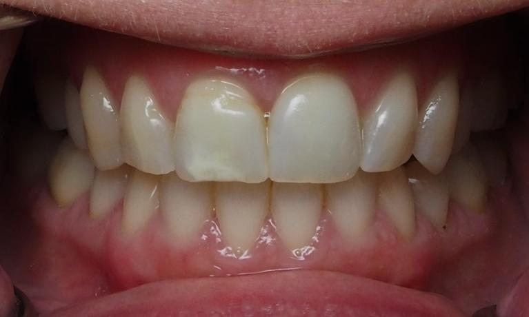 White-Spot-Treatment-with-ICON-Before-Image